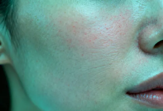 CO2 fractional laser skin resurfacing results